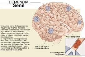 demenciasenil1